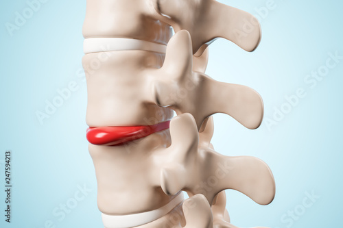 Human spinal intervertebral hernia. Disk spain degradation. 3d rendering.