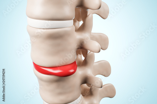 Human spinal system problem concept. Disk spain degradation. 3d rendering.