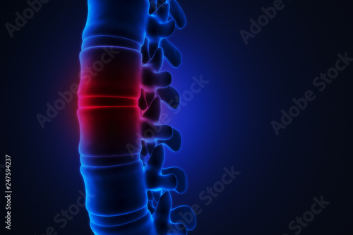 Human spinal pain concept. Disk spain degradation. X-ray illustration. 3d rendering.