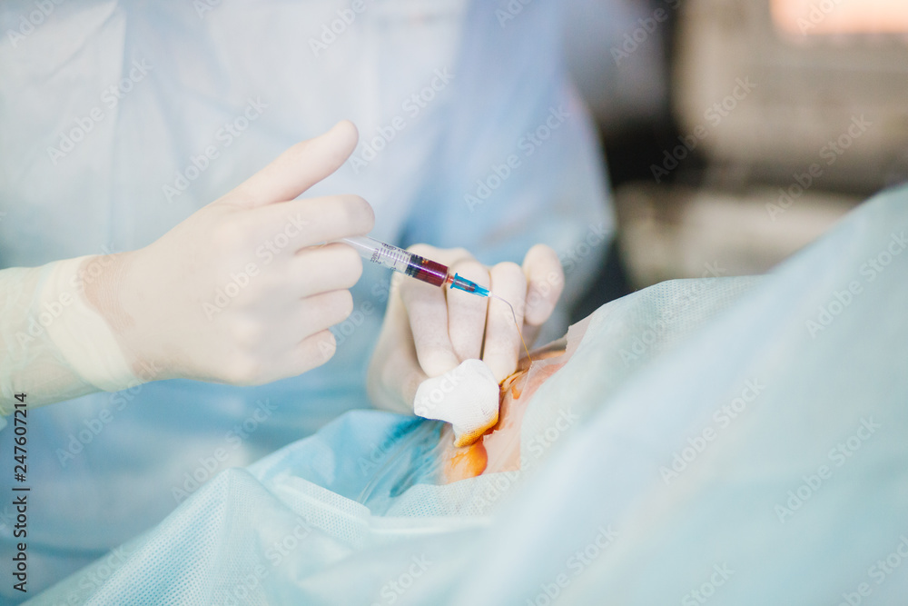 Retinal surgery. Ophthalmic eye surgery Retinal surgery. Ophthalmic eye surgery