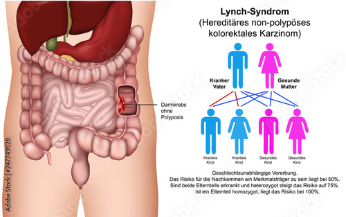 Lynch - Syndrom Vektor Illustration mit Erbfolge Beschreibung