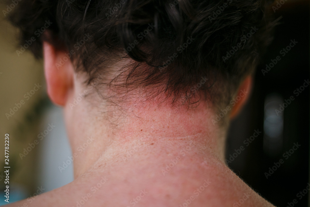Skin Allergy Symptoms of patient, Allergic skin reaction on the female neck and chest. Health problem. Psoriasis skin Skin Allergy Symptoms of patient, Allergic skin reaction on the female neck and chest. Health problem. Psoriasis skin