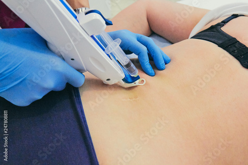 Female doctor doing mesotherapy treatment for back pain. Beauty and healthcare.