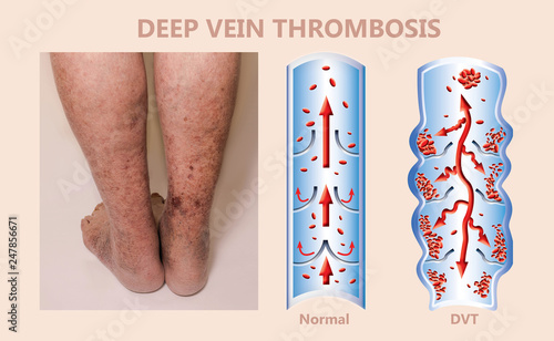 Vászonkép Economy class syndrome mechanism, deep vein thrombosis or DVT, Pulmonary Embolis