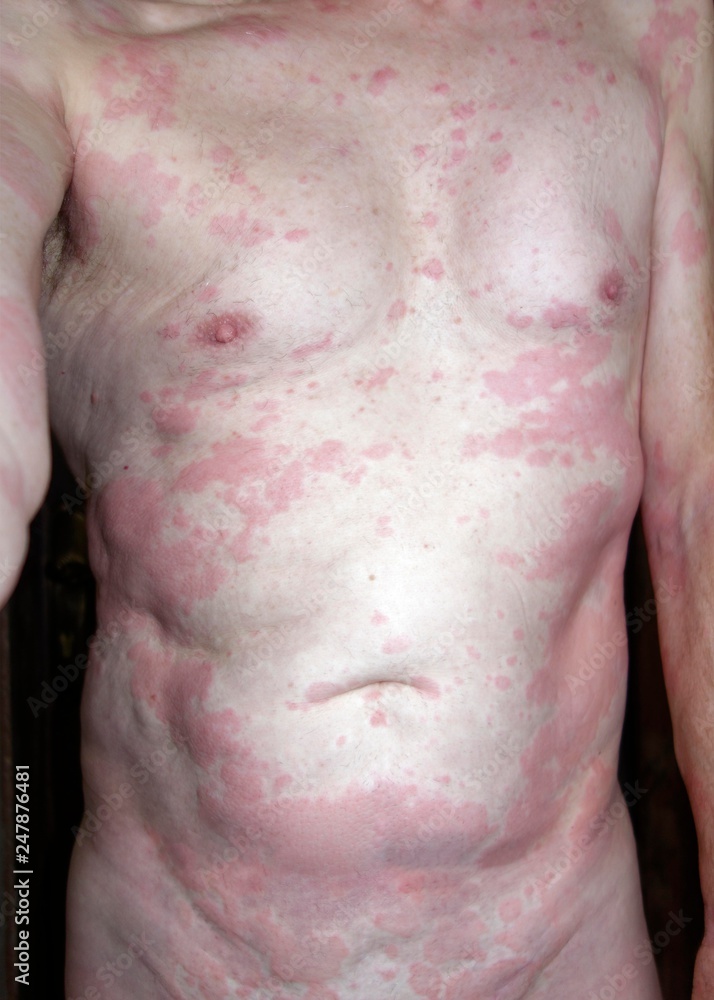 Foto de Man, 68 years old, with allergic reaction, skin rash, allergy ...
