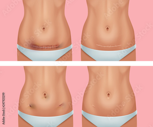 Vector set of fresh and healed scars on body after abdomen, wound from appendicitis removal surgery on background