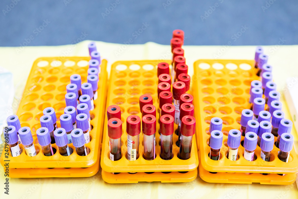 Test Tubes Of Blood For Analysis In The Tray During The Blood Donation Campaign. Test Tubes Of Blood For Analysis In The Tray During The Blood Donation Campaign.