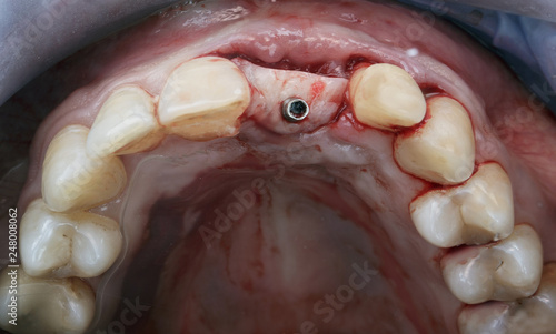 operation for implantation in soft tissue adding abutment
