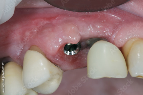 Dental gums after implantation, preparation for crowns