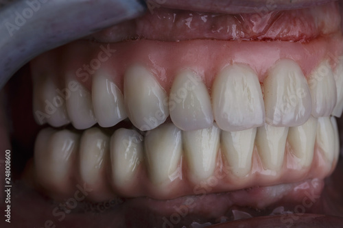 Modern Dental prosthesis for the patient after the implant
