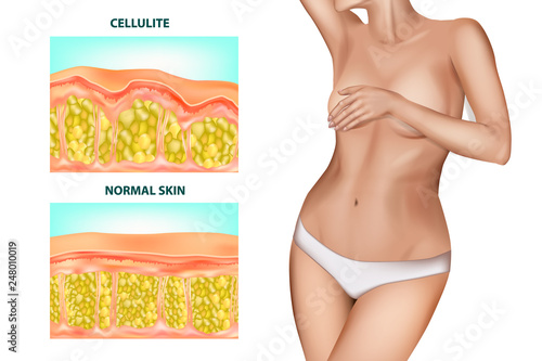 Skin cross section of Cellulite formation. Banner with the realistic beautiful women without cellulite