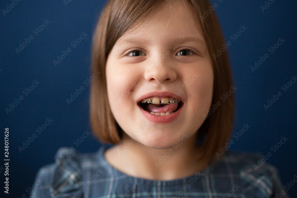 Portrait of kid girl with bracket on teeth on blue Portrait of kid girl with bracket on teeth on blue