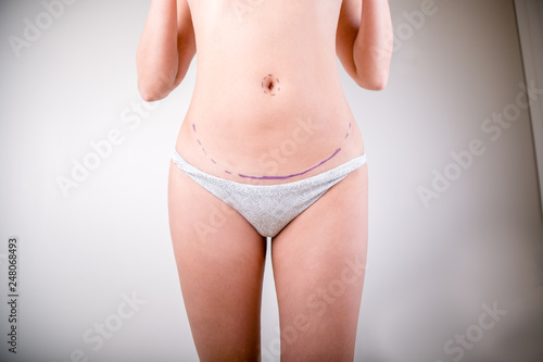 Surgeon drawing marks on female body before plastic operation  white background. Beautician touch and draw correction lines on woman s buttocks.