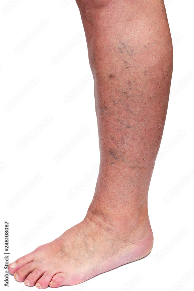 The varicose veins