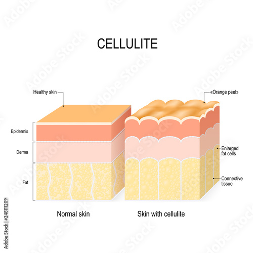 cellulite. Cross section of a healthy skin and skin with Orange peel.