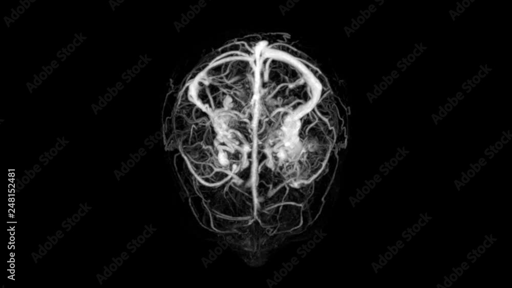 Mri Visualization MRI Scan ,Brain Arteries and Veins animation Stock Video | Adobe Stock