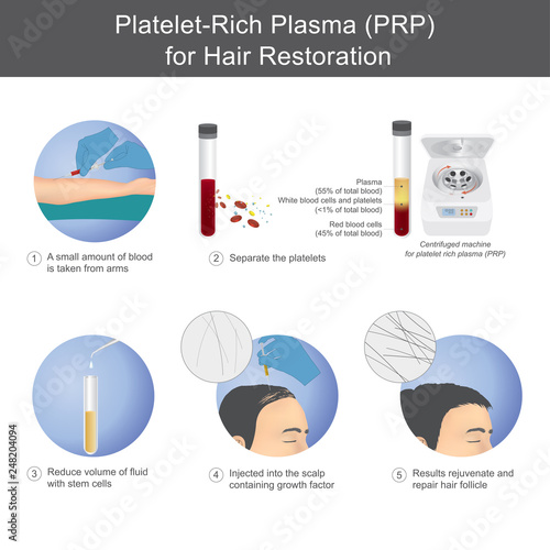 Stimulation of hair growth by using blood from service recipients through the process of separating platelet rich plasma, To be injected onto the scalp.