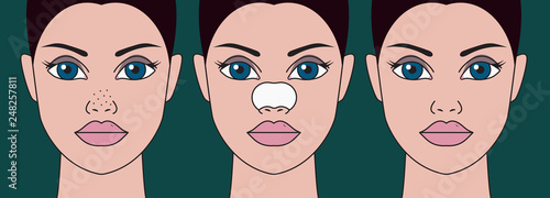 Cleansing of blackheads