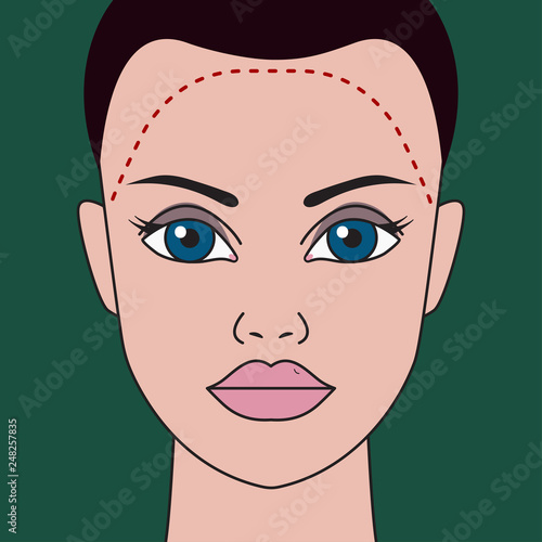 correction of receding hairline