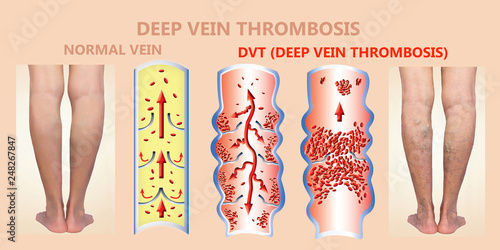 Photography Deep Vein Thrombosis or Blood Clots. Embolus.