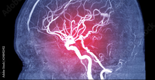 Konstfotografi Magnetic resonance image (MRI) of Vessel in the brain sagittal view or MRA brain