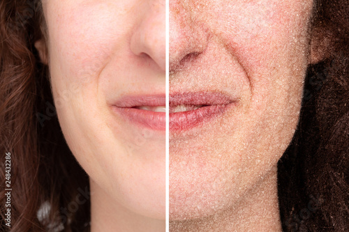 Rappresentation of woman hal face with dry skin  before and after beauty treatment