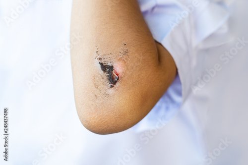 Photos wound have scab on the elbow of the child