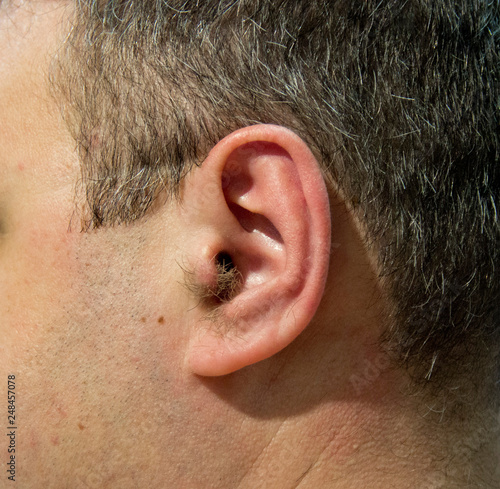 Strongly hairy ear