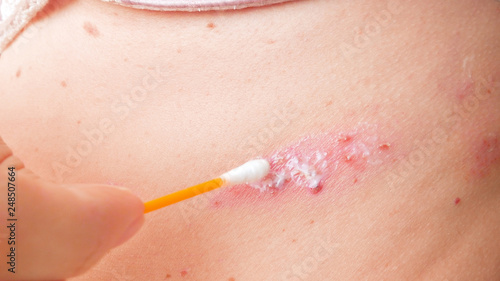 Quadro su tela hand with cotton swab treatment of skin rash on woman body by ointment
