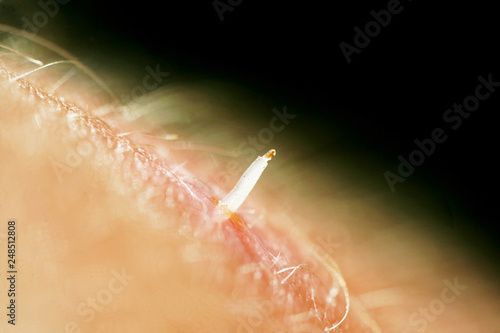 bot fly larvae inside flesh