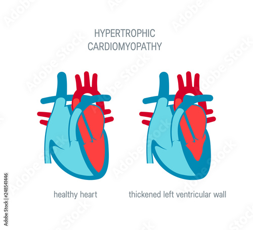 Heart disease vector concept in flat style photo