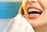 Closeup dental braces checkup 