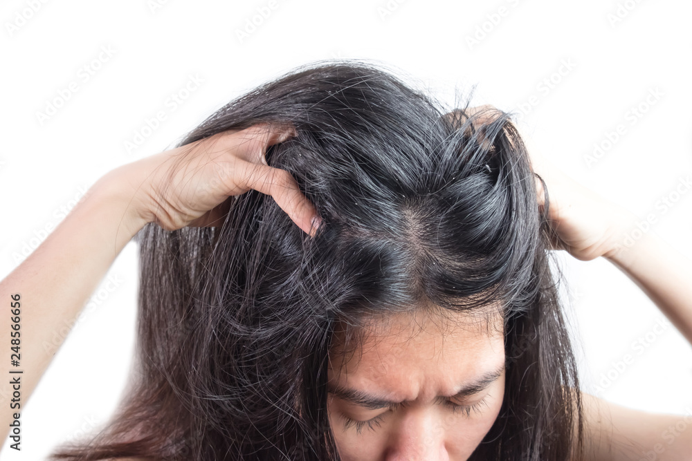 Fototapeta premium women head with dandruff Caused by the problem of dirty. Or caused by skin disease or Seborrheic Dermatitis. It has white scaly and it will cause itch.