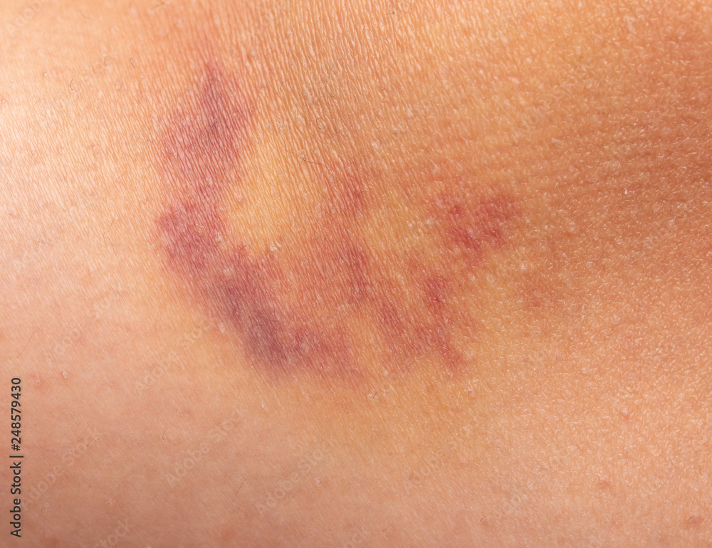 bruise on the skin bruise on the skin