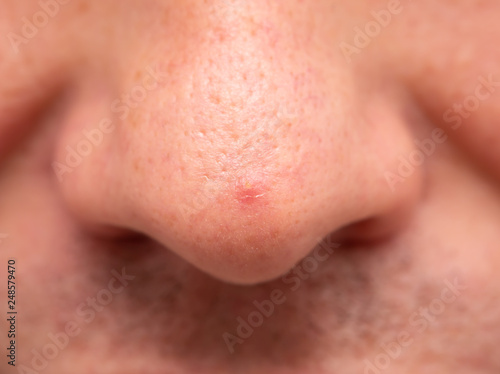 pimple on the nose