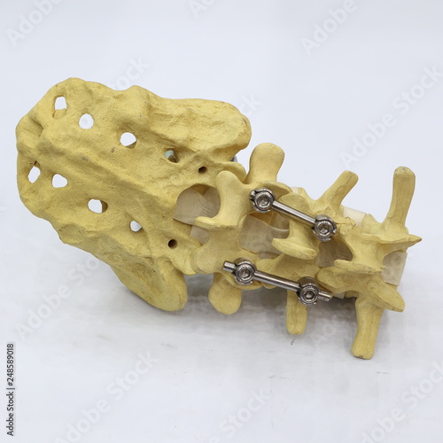 Foto Spinal fixation system - titanium bracket