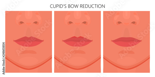 Vector illustration. Getting rid of upper lip Cupid’s bow on face before, after aesthetic plastic surgery. Close up view. For advertising of medicinal, cosmetic, procedures