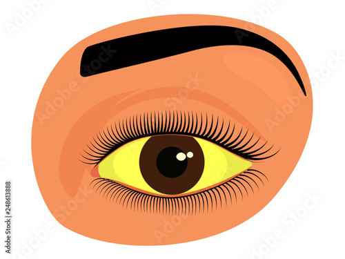 Vector illustration of a yellowed human eye as a symptom of hepatitis. For advertisement of drops and other medications, for medical publications