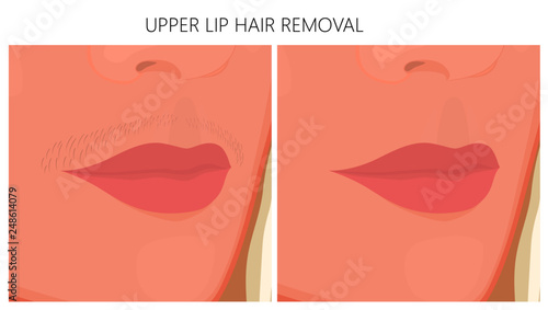 Vector illustration of upper Lip Hair removal before and after cosmetic procedure. For advertising and beauty publications