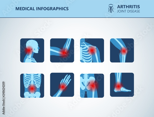 Rheumatism or rheumatic disorder medical set. Arthritis joint pain syndrome. Different body parts with pain rings on hand, leg and feet, spine, scull, pelvis. Rheumatology vector infographics elements