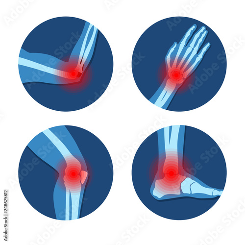 Rheumatism or rheumatic disorder medical set. Arthritis joint pain syndrome. Different body parts with pain rings on hand, elbow, knee and feet. Rheumatology vector infographics elements