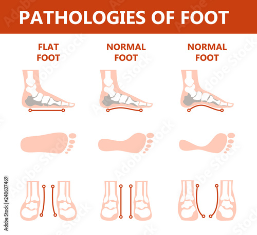 Foot pathologies infographic. Flat foot anatomy. Deformed