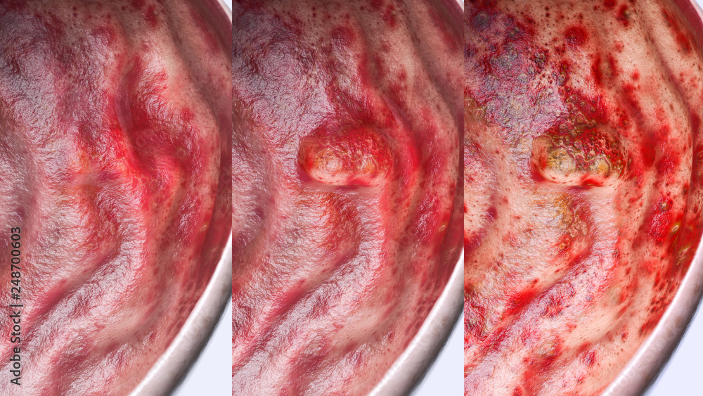 Αυτοκόλλητο Gastric ulcer in various stages- high degree of detail - 3D Rendering