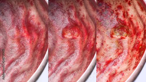Gastric ulcer in various stages- high degree of detail - 3D Rendering photo