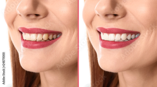 Smiling woman before and after teeth whitening procedure  closeup