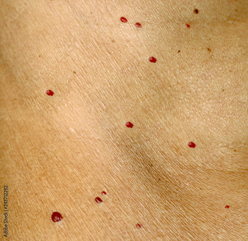 Angioma on the skin. Red moles on the body. Many birthmarks. photo