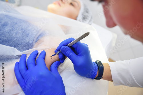 Fotografie Medical surgical treatment removal of a mole on the hand of a young woman patient