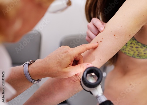 Doctor examining birthmarks and moles patient. examination of birthmarks and moles.the doctor examines the patient's mole