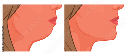 Vector illustration. A female face before, after plastic surgery - chin augmentation. Close up view. For advertising of plastic surgery, medical and beauty publications