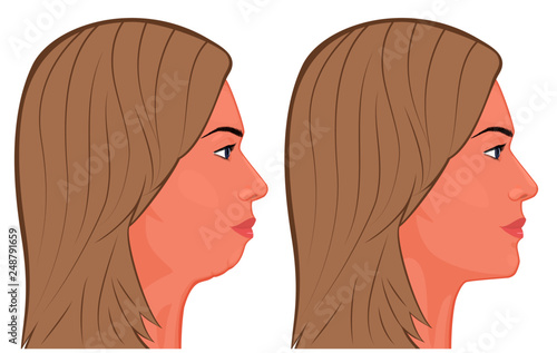 Vector illustration. A female face before, after plastic surgery - chin augmentation. Close up view. For advertising of plastic surgery, medical and beauty publications
